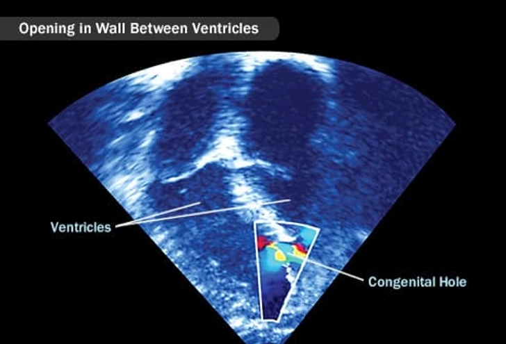 Congenital Heart Defects