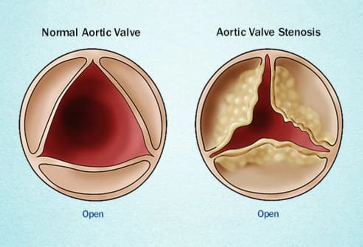 Heart Valve Disease