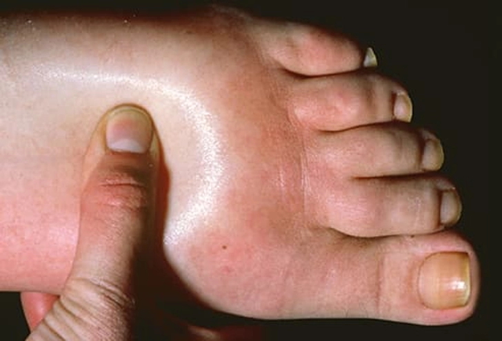 Effects of Cardiomyopathy