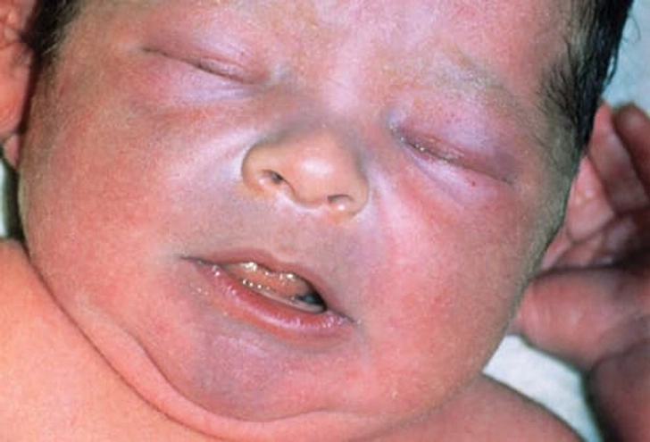How Heart Defects Affect Your Body