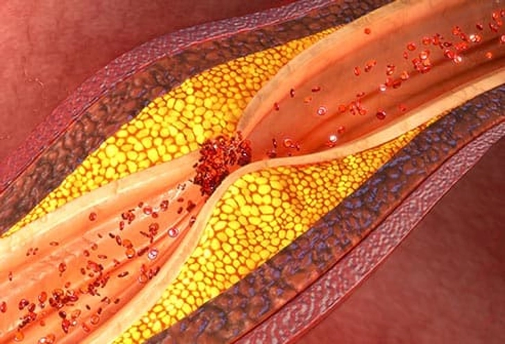 Coronary Heart Disease (CHD)