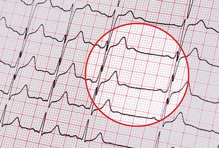 When Your Heart Loses Its Rhythm When Your Heart Loses Its Rhythm