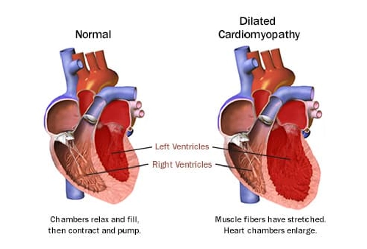 Cardiomyopathy Cardiomyopathy