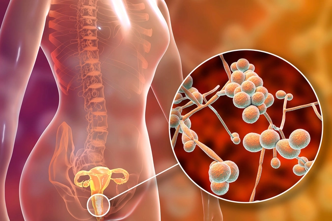 More Frequent Yeast Infections