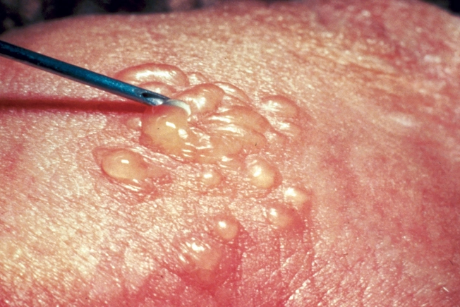 STD Severity