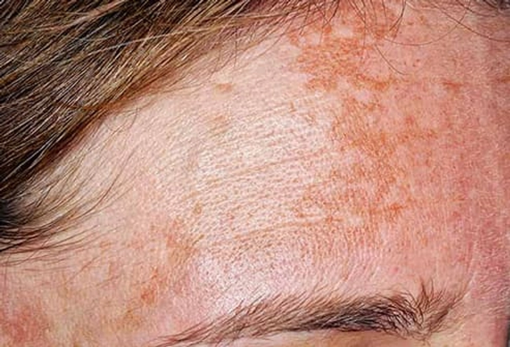 Avoiding Melasma