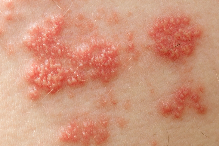Shingles
