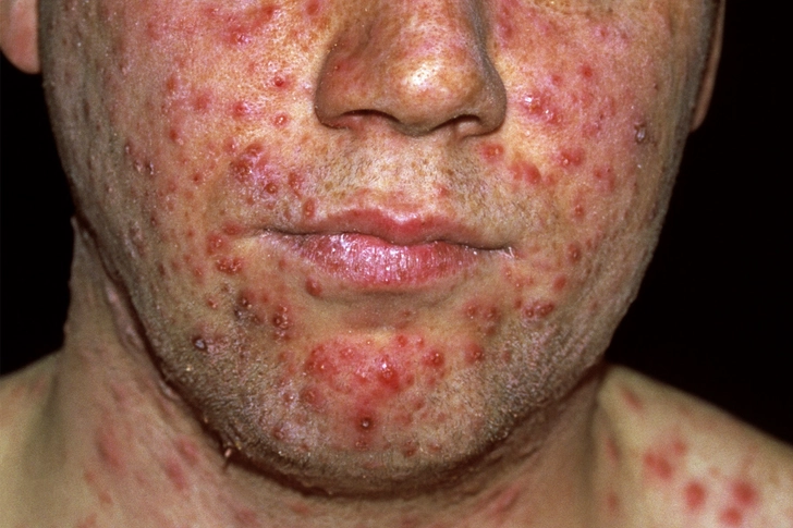 Chickenpox