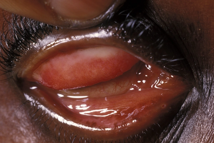 Conjunctivitis (Pinkeye)