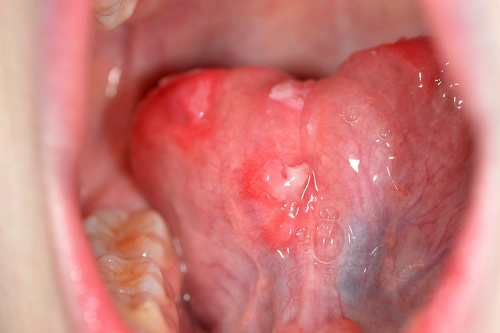 Hand, Foot, and Mouth Disease
