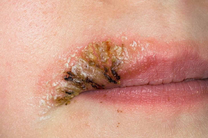 Impetigo