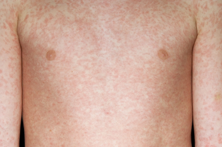 Measles