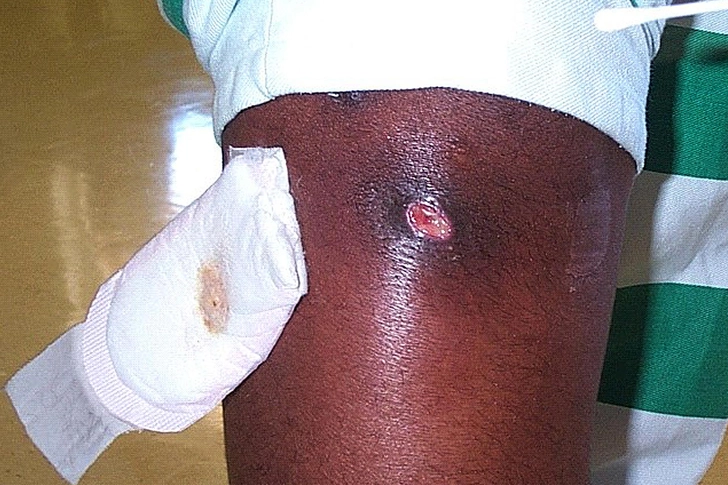 MRSA
