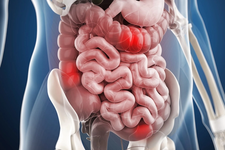 Irritable Bowel Syndrome