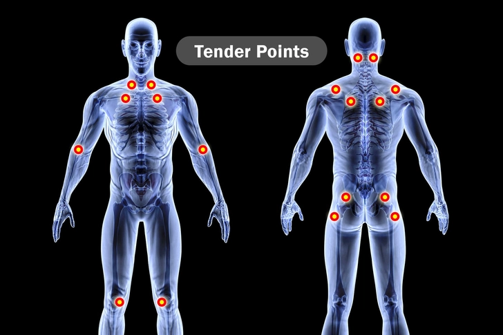 Fibromyalgia