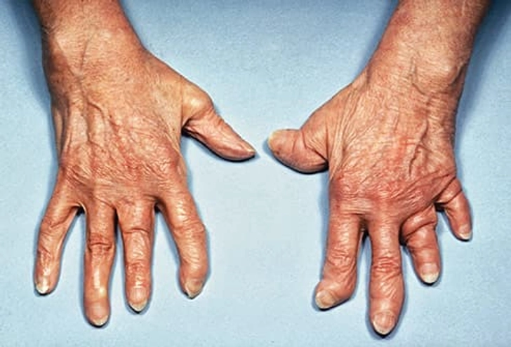 Deformed Hands and Feet