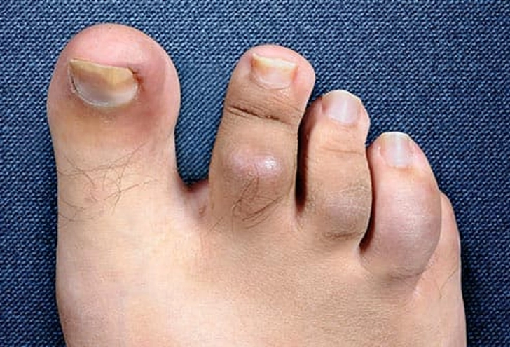 Foot Problems