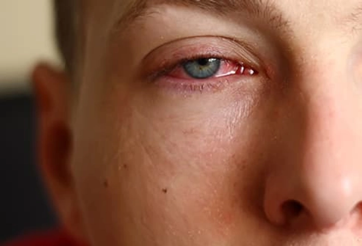 Red Eyes