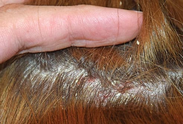 Flaky Scalp