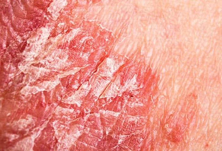 Skin Symptoms