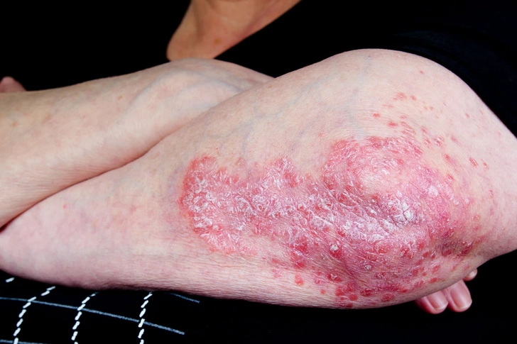 Plaque Psoriasis