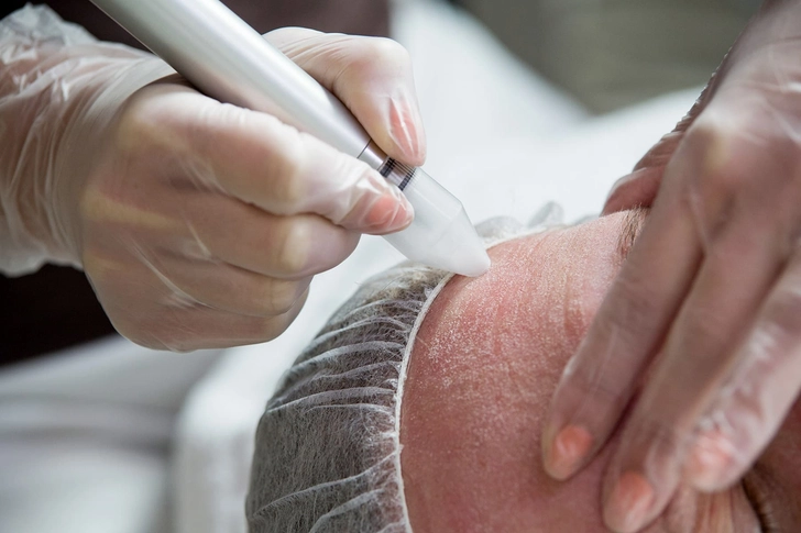 Dermabrasion Dermabrasion
