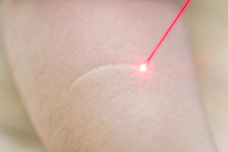 Laser Therapy