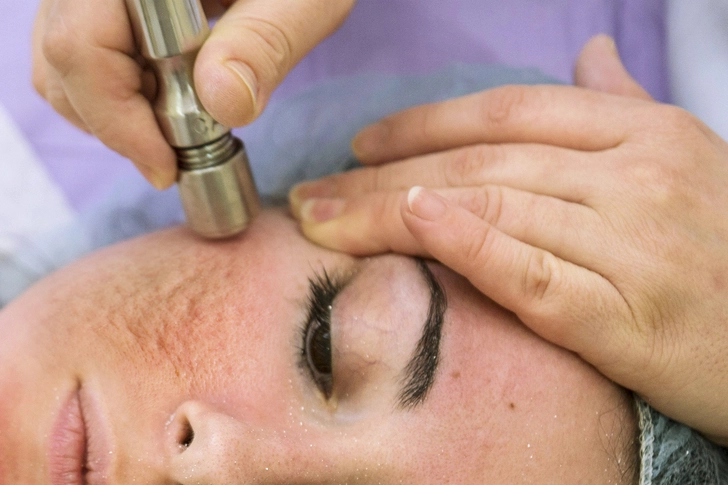 Chemical Peel or Dermabrasion