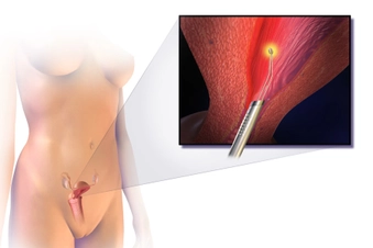 Ask About Endometrial Ablation Ask About Endometrial Ablation