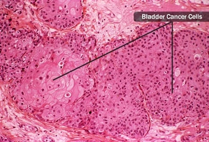 Problem: Bladder Cancer Problem: Bladder Cancer
