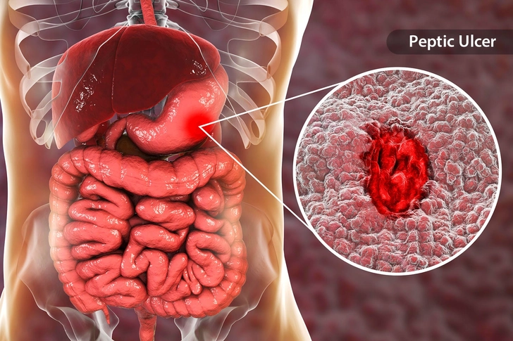 Ulcers
