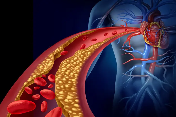 Heart Disease