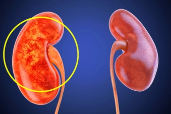 Gut Bacteria and Your Kidneys Gut Bacteria and Your Kidneys