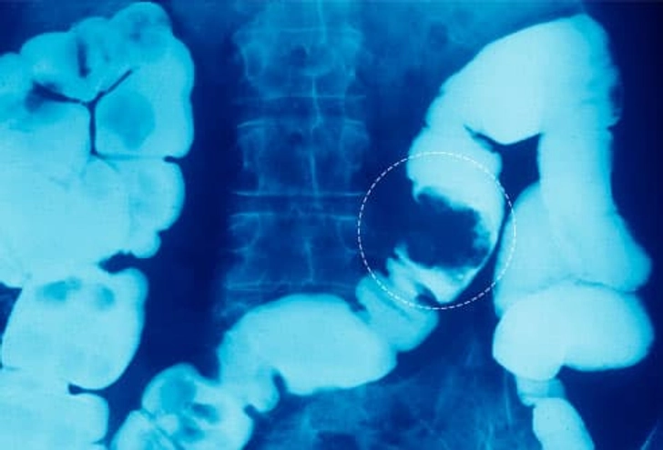 Complications: Obstruction Complications: Obstruction