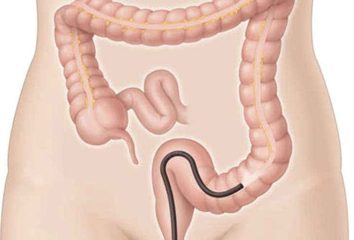 Colonoscopy