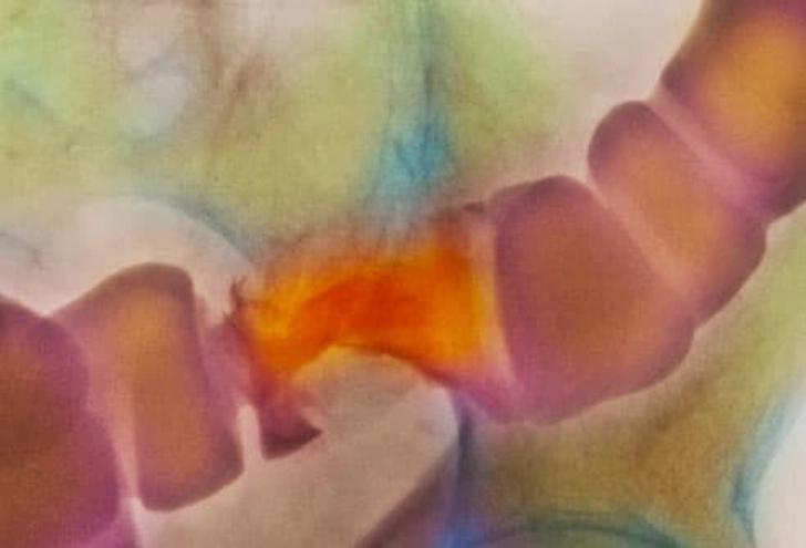 Barium X-ray