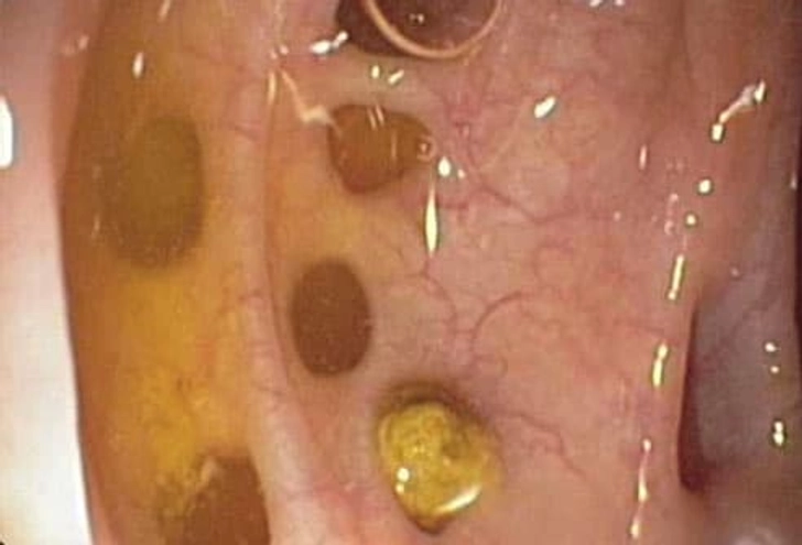 Conditions That Mimic IBD Conditions That Mimic IBD