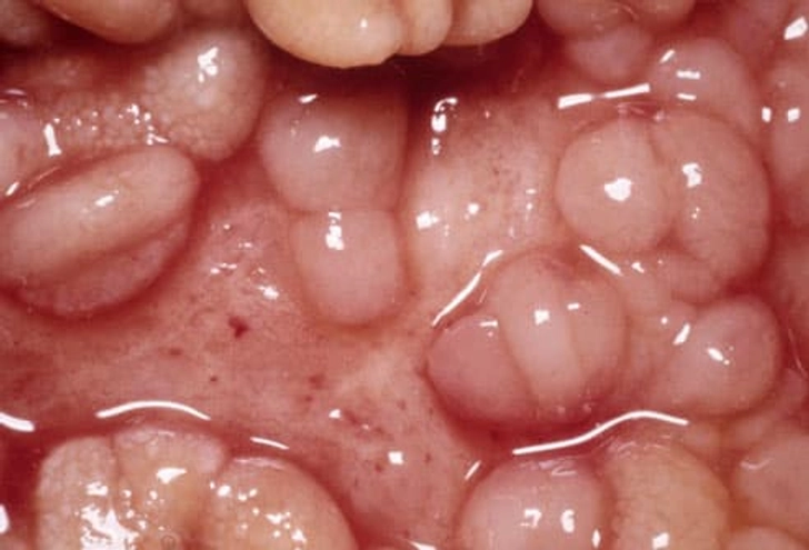 Types of IBD: Crohn's Disease