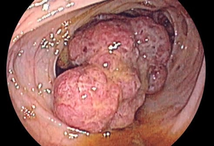 Does IBD Cause Colon Cancer? Does IBD Cause Colon Cancer?