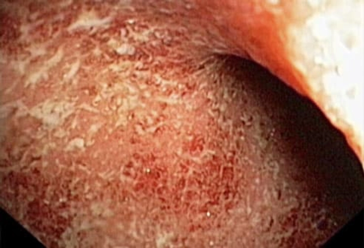 Types of IBD: Ulcerative Colitis