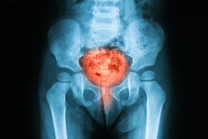 Painful Bladder Syndrome Painful Bladder Syndrome