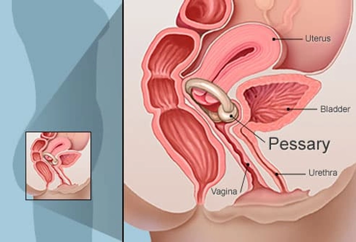 Pessary Pessary