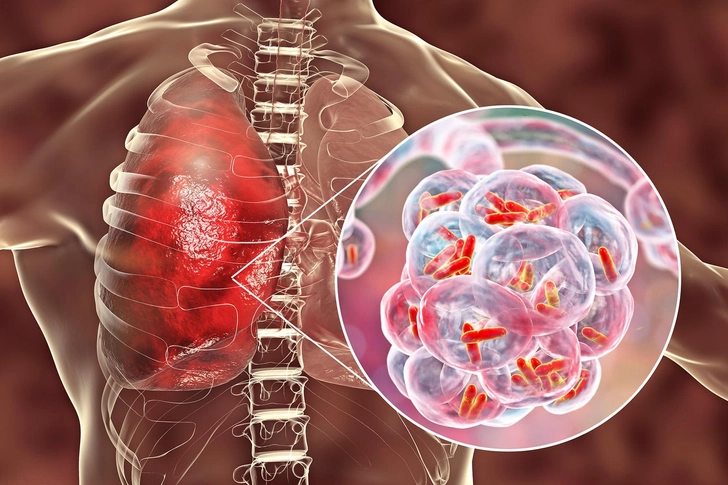 Legionnaires Disease