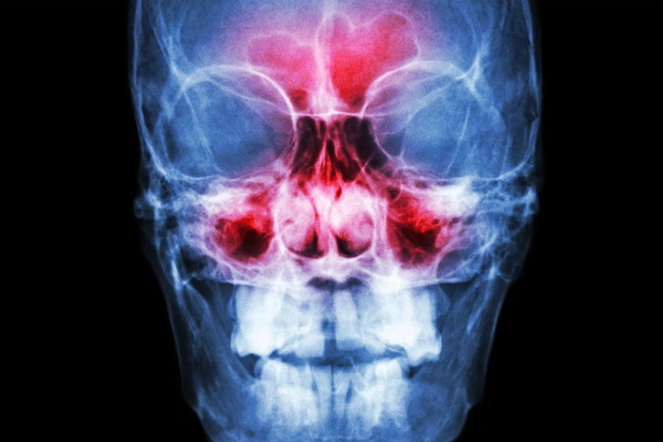 Sinus Infection (Sinusitis)