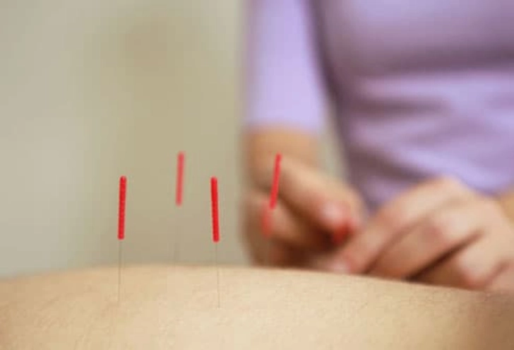 Does Acupuncture Help? Does Acupuncture Help?