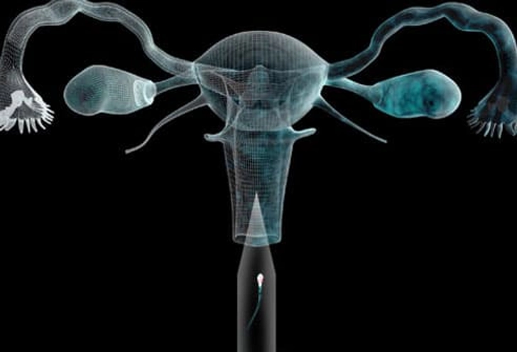 Intrauterine Insemination (IUI) Intrauterine Insemination (IUI)