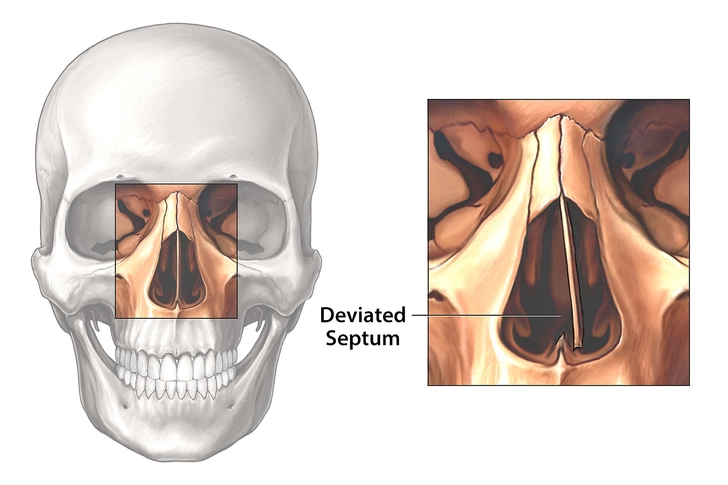 Deviated Septum Deviated Septum