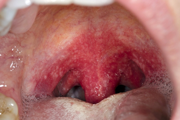 Strep Throat Strep Throat