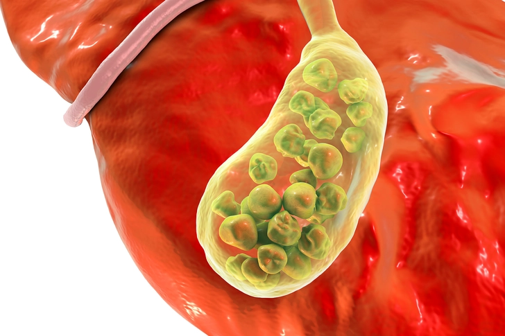 Gallstones