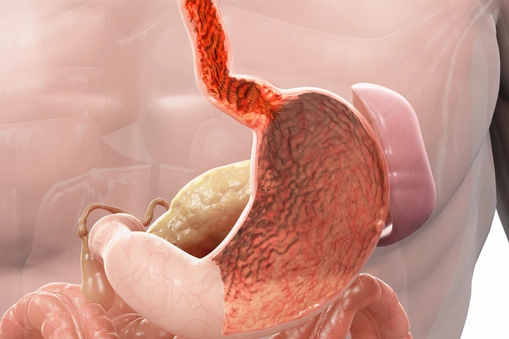 Esophagitis